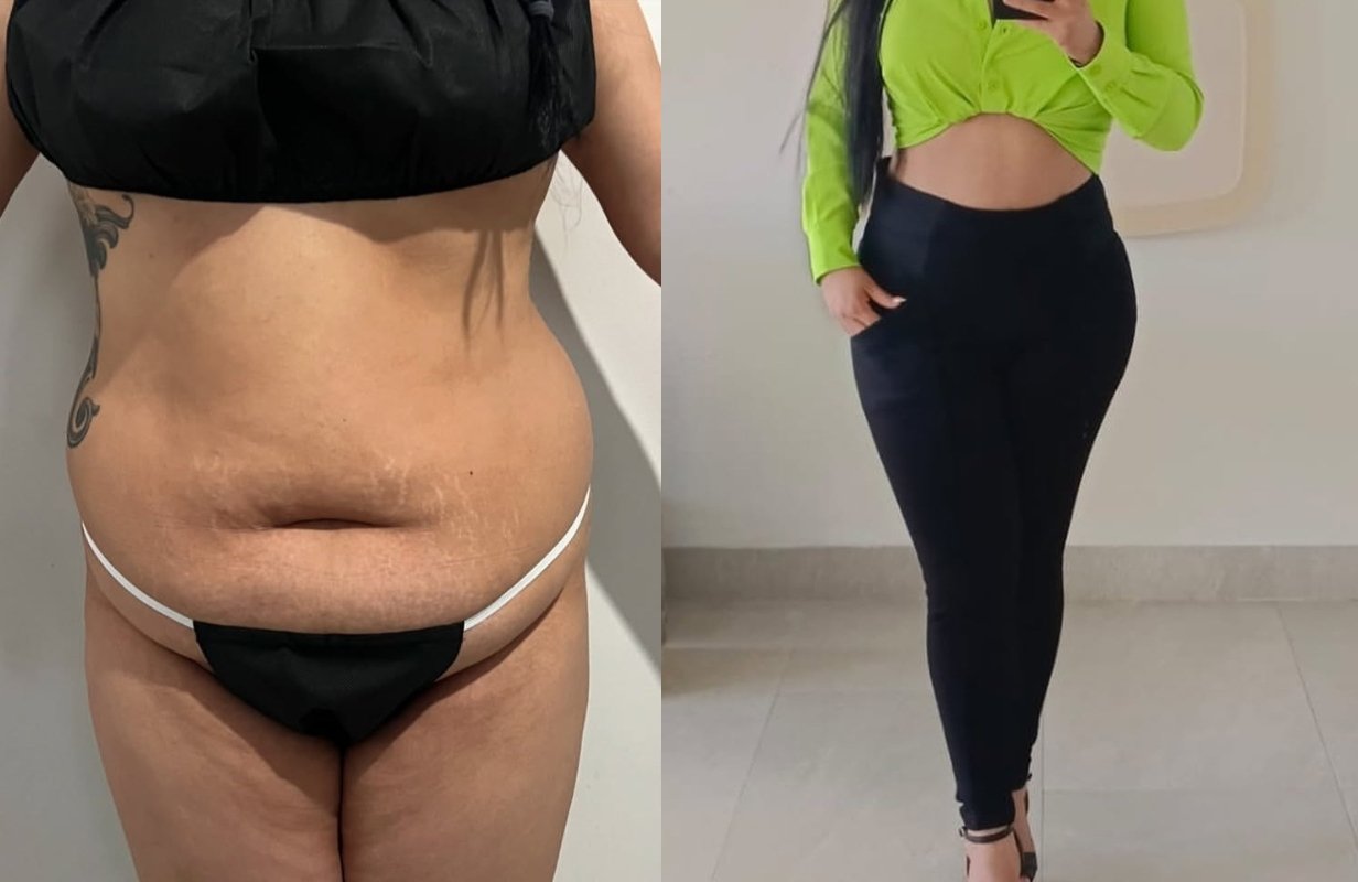 Lipoabdominoplastia Monterrey. Dr Efrén Ochoa. Cirujano Plástico en Monterrey 1 (10)