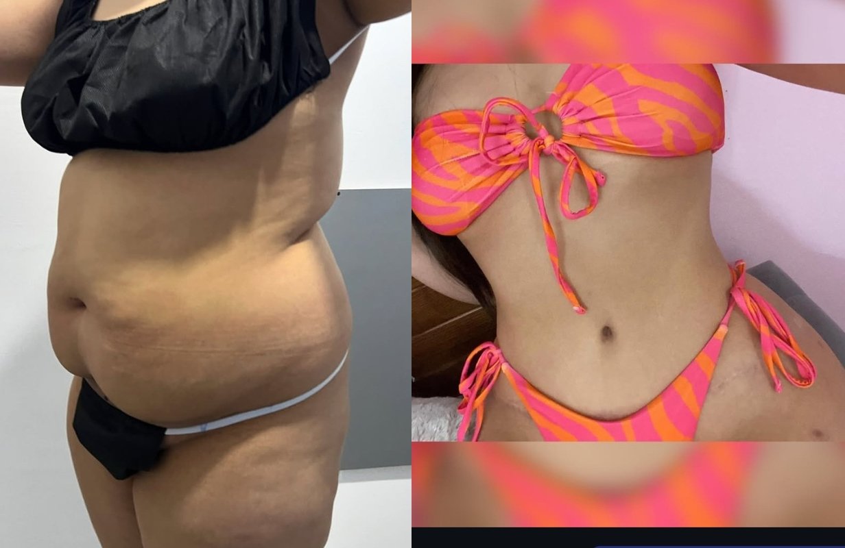 Lipoabdominoplastia Monterrey. Dr Efrén Ochoa. Cirujano Plástico en Monterrey 1 (11)
