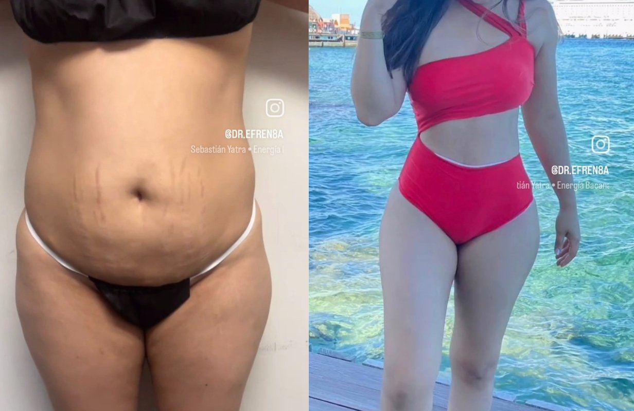 Lipoabdominoplastia Monterrey. Dr Efrén Ochoa. Cirujano Plástico en Monterrey 1 (12)