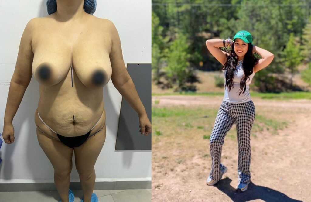 Lipoabdominoplastia Monterrey. Dr Efrén Ochoa. Cirujano Plástico en Monterrey 1 (13)