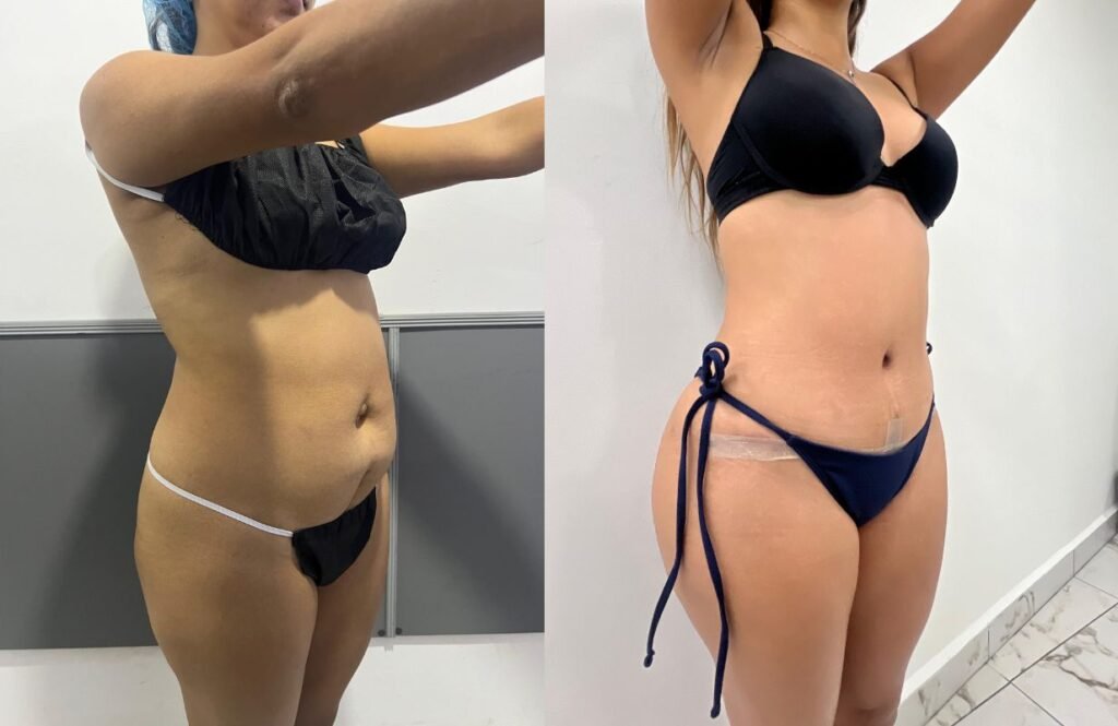 Lipoabdominoplastia Monterrey. Dr Efrén Ochoa. Cirujano Plástico en Monterrey 1 (2)