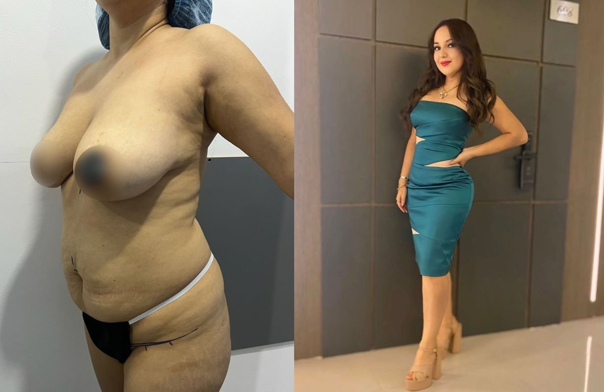 Lipoabdominoplastia Monterrey. Dr Efrén Ochoa. Cirujano Plástico en Monterrey 1 (5)