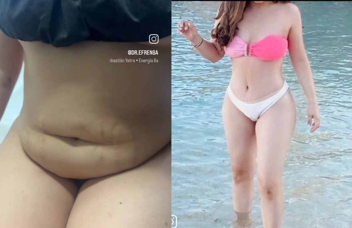 Lipoabdominoplastia Monterrey. Dr Efrén Ochoa. Cirujano Plástico en Monterrey 1 (7)