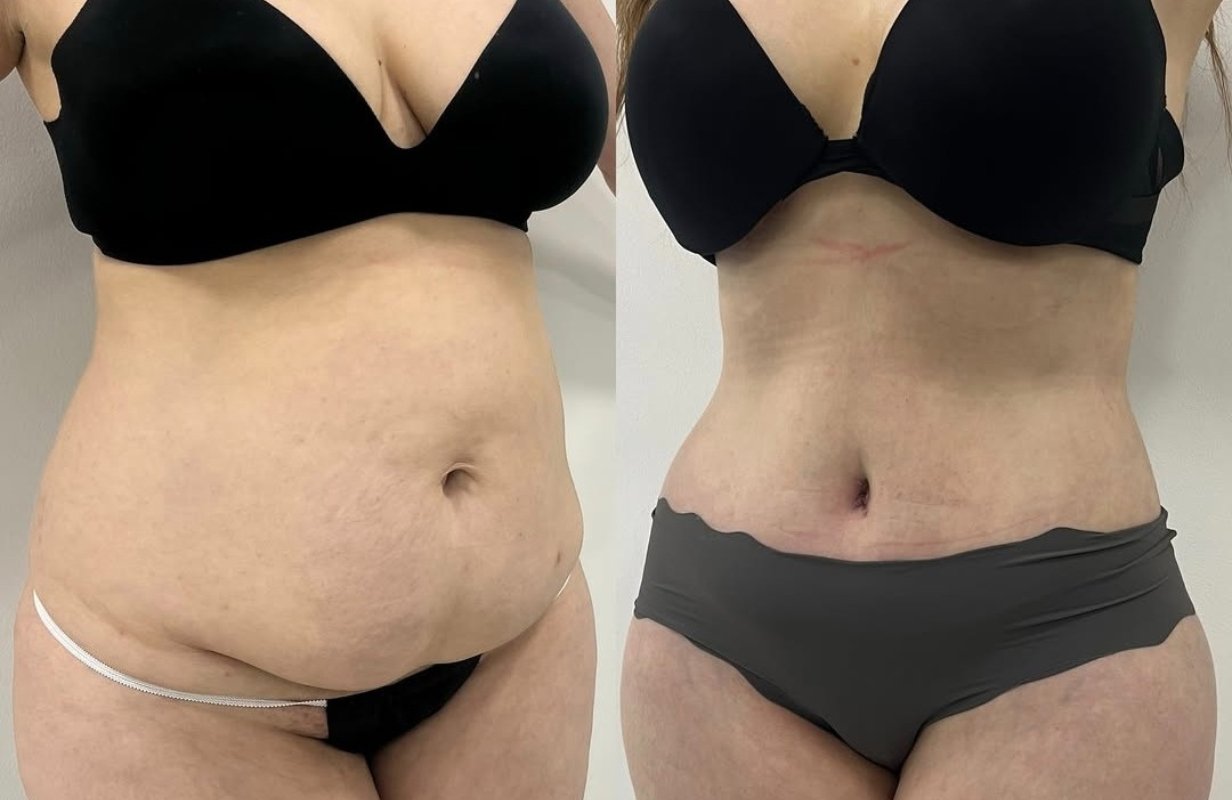 Lipoabdominoplastia Monterrey. Dr Efrén Ochoa. Cirujano Plástico en Monterrey 1 (8)