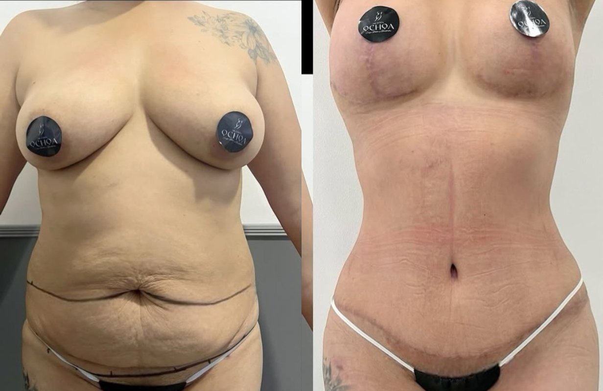 Lipoabdominoplastia Monterrey. Dr Efrén Ochoa. Cirujano Plástico en Monterrey 1 (9)