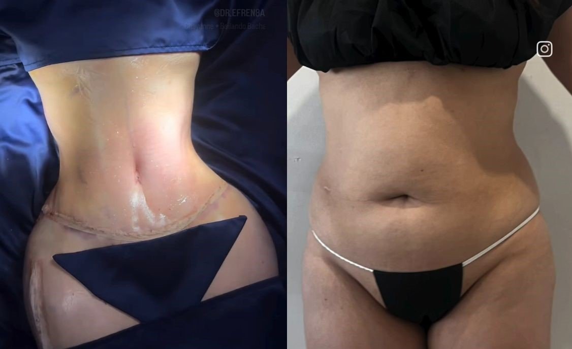 Lipoabdominoplastia Monterrey. Dr Efrén Ochoa. Cirujano Plástico en Monterrey 1 (5)
