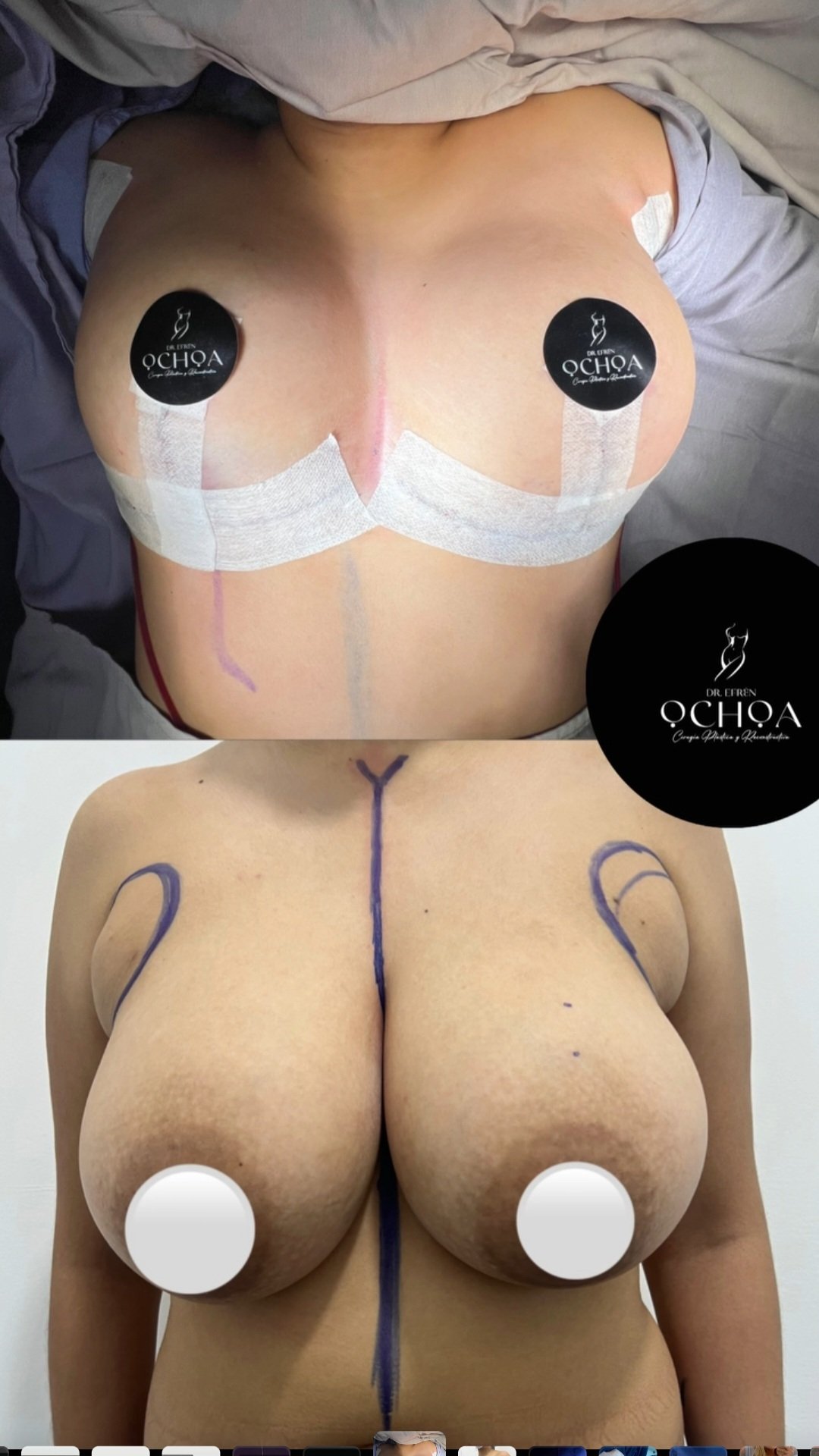 Mastopexia en Monterrey. Dr Efrén Ochoa (1)