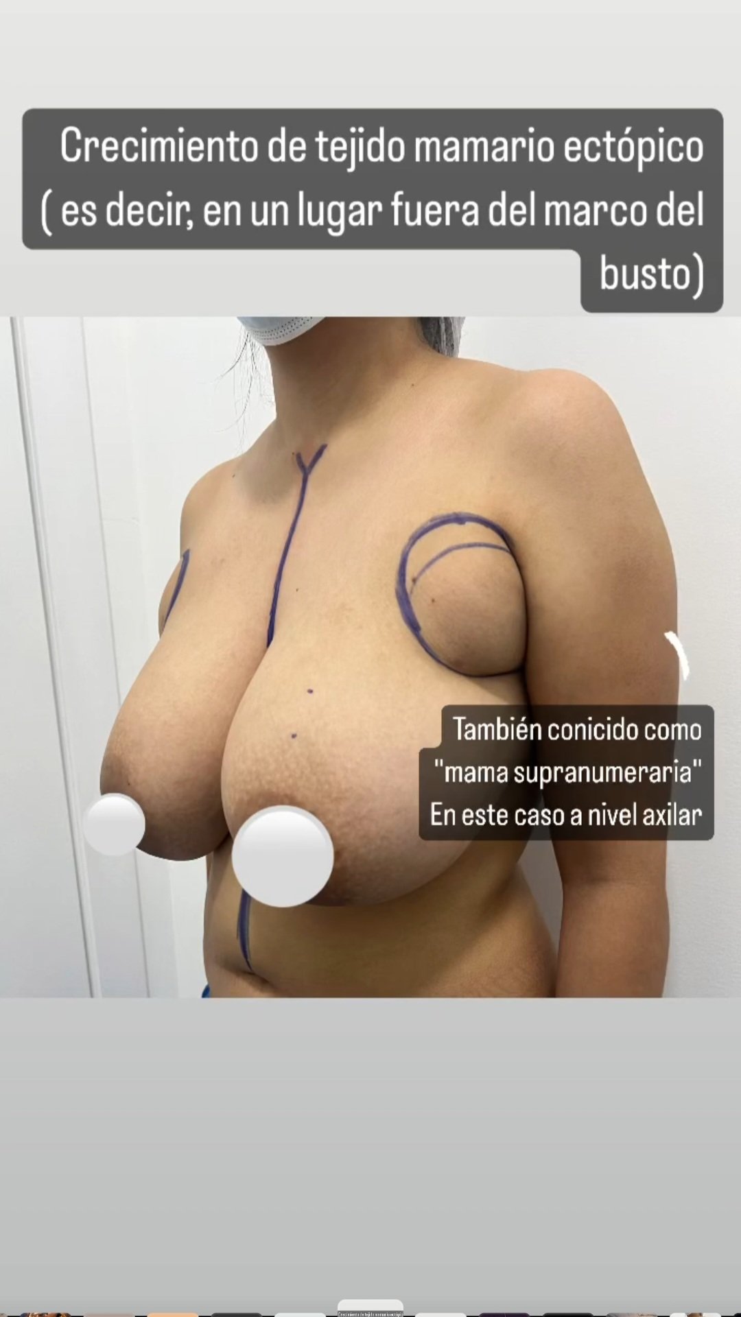 Mastopexia en Monterrey. Dr Efrén Ochoa (10)