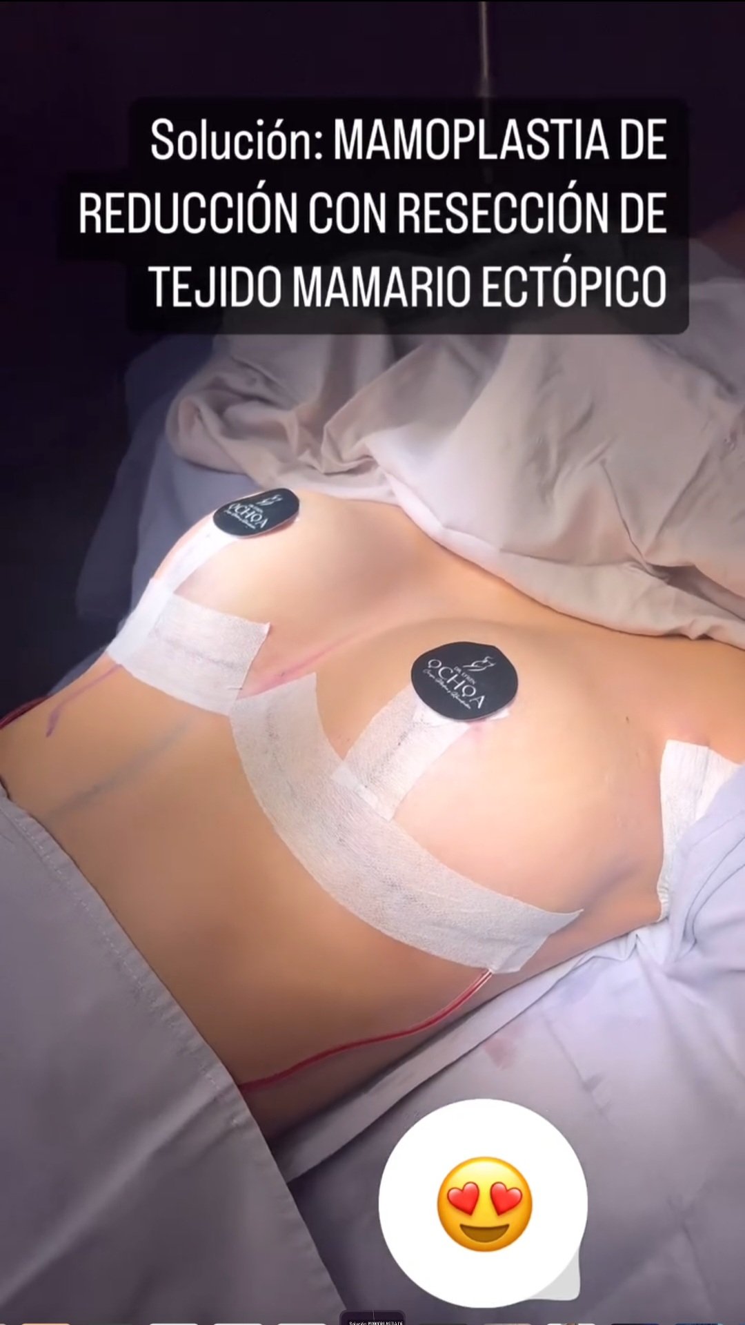 Mastopexia en Monterrey. Dr Efrén Ochoa (11)