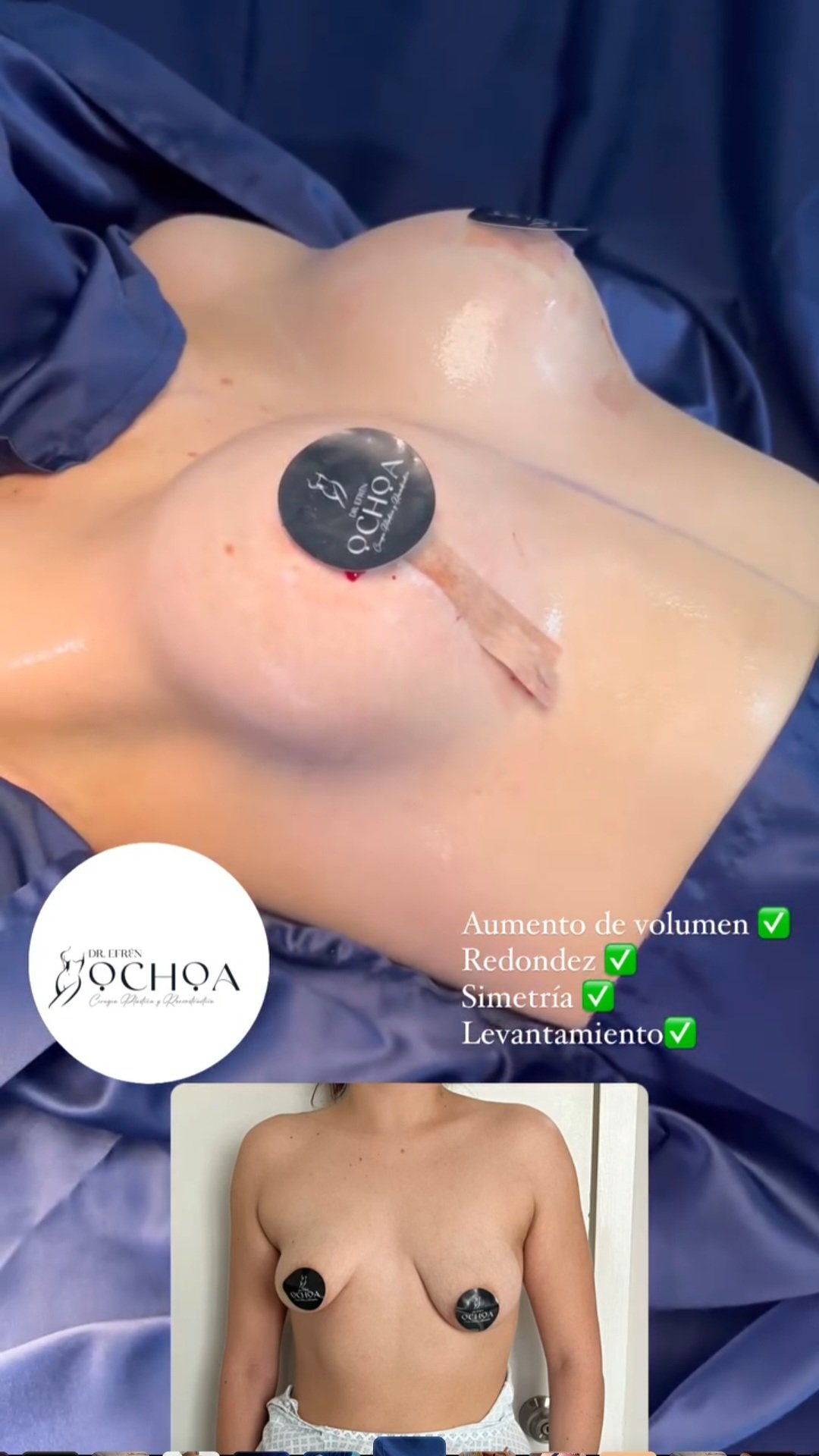 Mastopexia en Monterrey. Dr Efrén Ochoa (12)