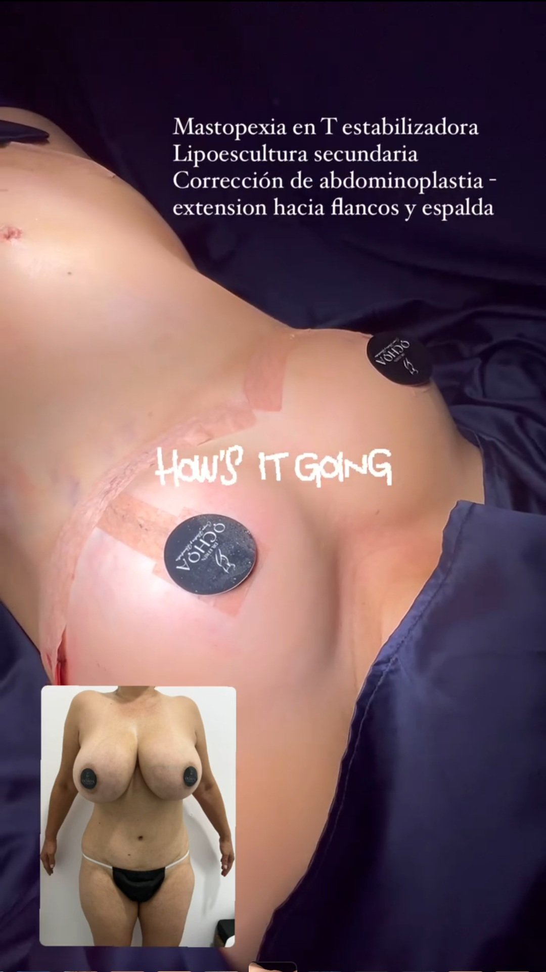 Mastopexia en Monterrey. Dr Efrén Ochoa (13)