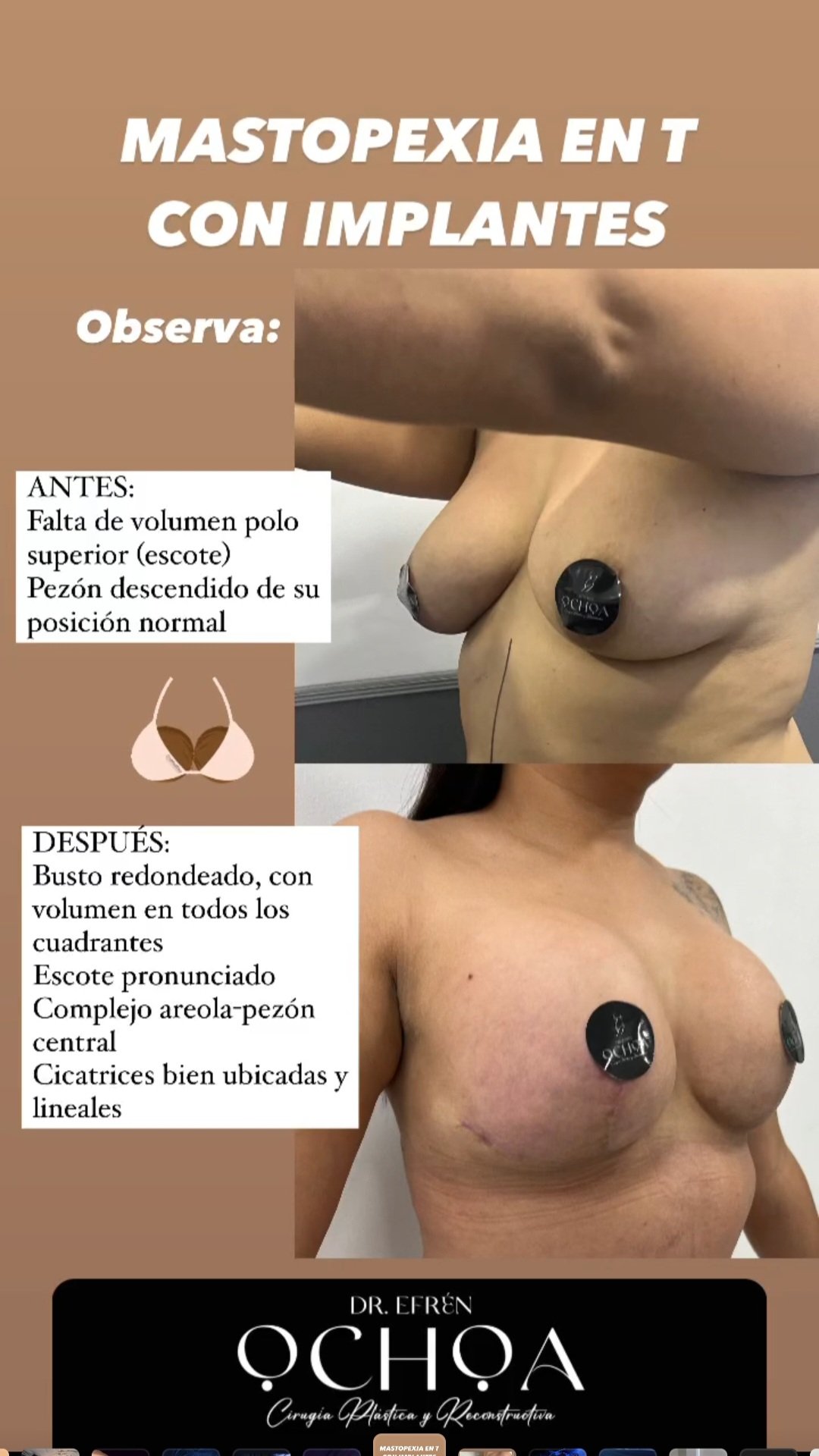 Mastopexia en Monterrey. Dr Efrén Ochoa (15)