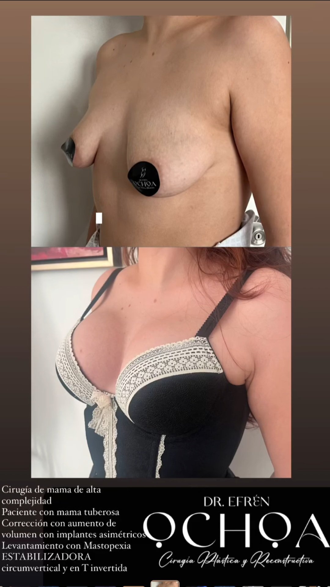 Mastopexia en Monterrey. Dr Efrén Ochoa (16)