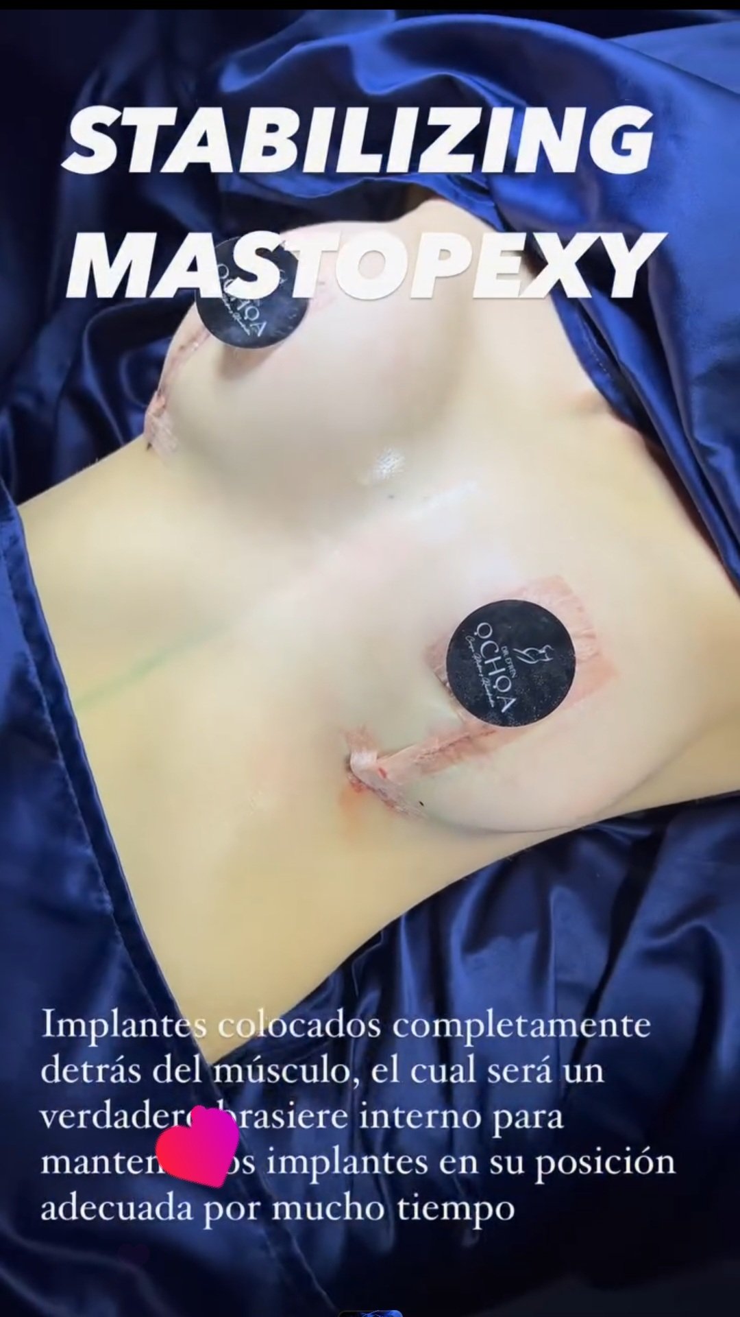 Mastopexia en Monterrey. Dr Efrén Ochoa (17)