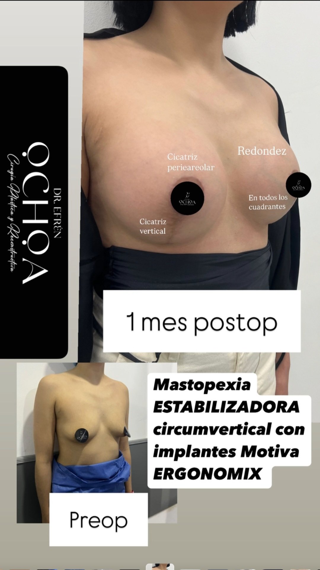 Mastopexia en Monterrey. Dr Efrén Ochoa (3)