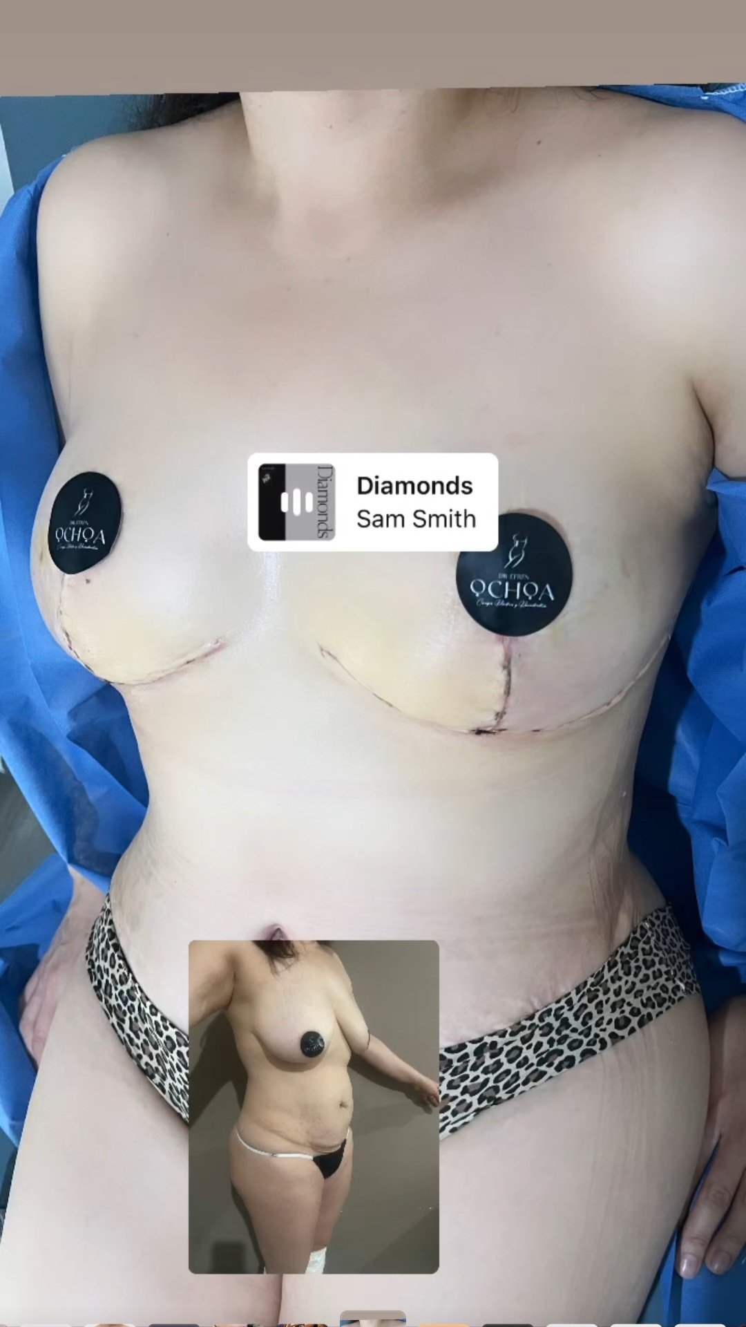 Mastopexia en Monterrey. Dr Efrén Ochoa (8)