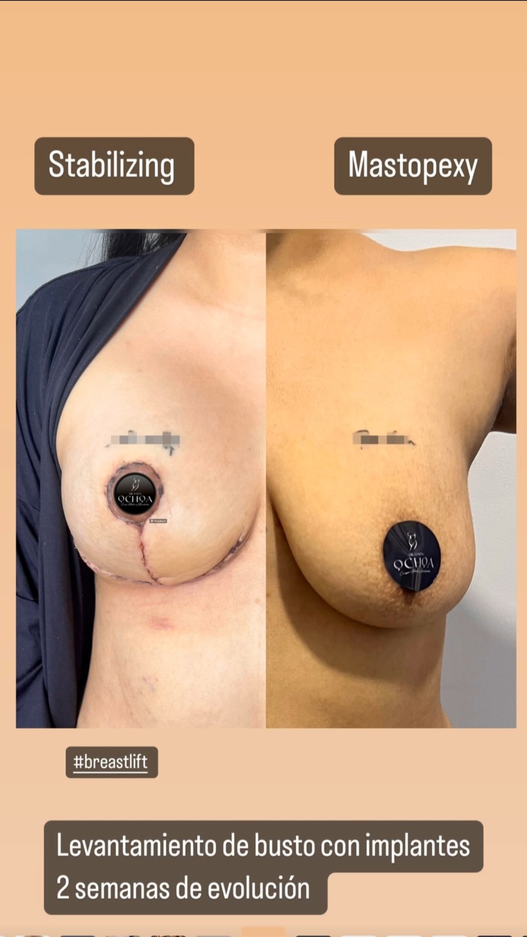 Mastopexia en Monterrey. Dr Efrén Ochoa (9)